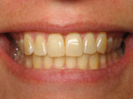 Before Whitening