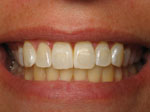 After Whitening